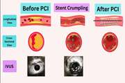 چروکیدگی استنت: خطری پنهان در درمان رگ‌های قلب