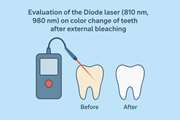 Evaluation of the Diode laser (810nm, 980 nm) on color change of teeth after external bleaching