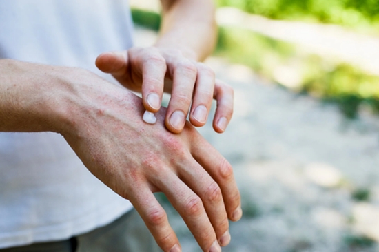 Air pollution may be a risk factor for psoriasis, a chronic inflammatory skin disease. 
